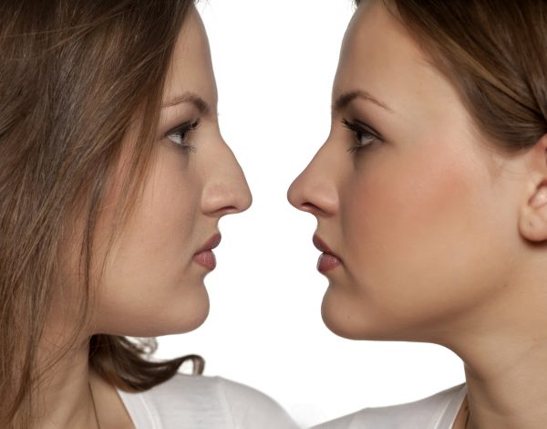 comparative portrait of a young woman before and after rhinoplasty