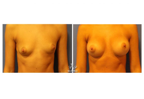 Breast asymmetry corrections