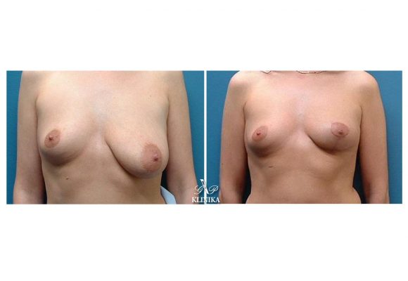 Breast lift and reduction