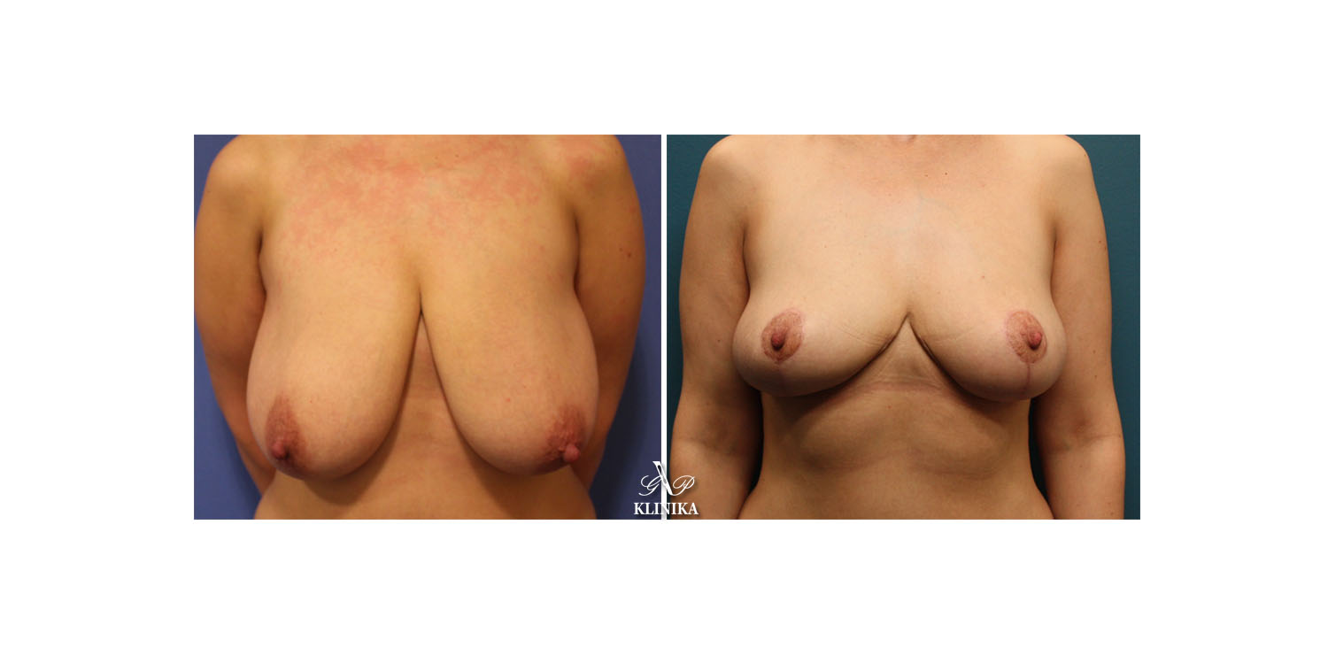 Breast lift and reduction