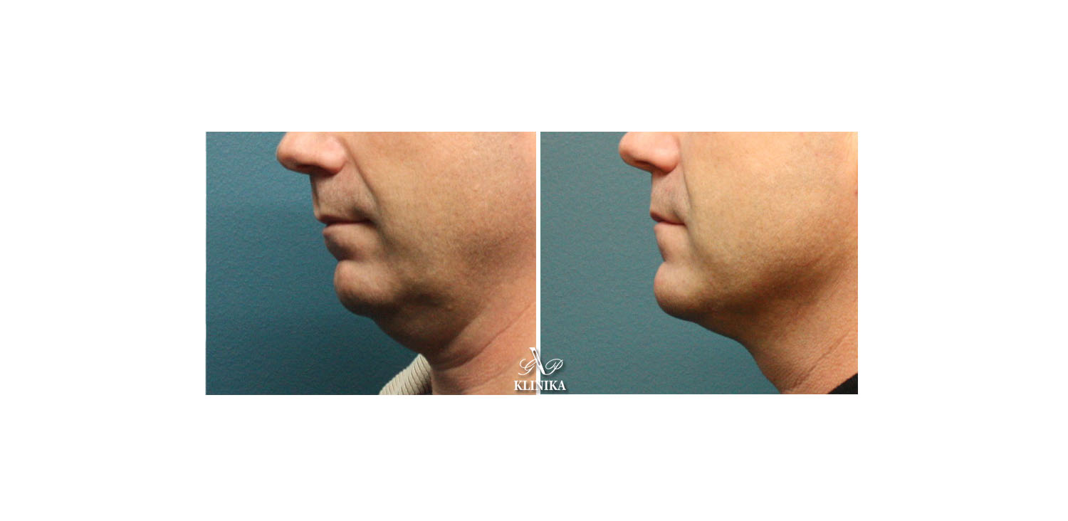 Corrections of the lower part of the chin