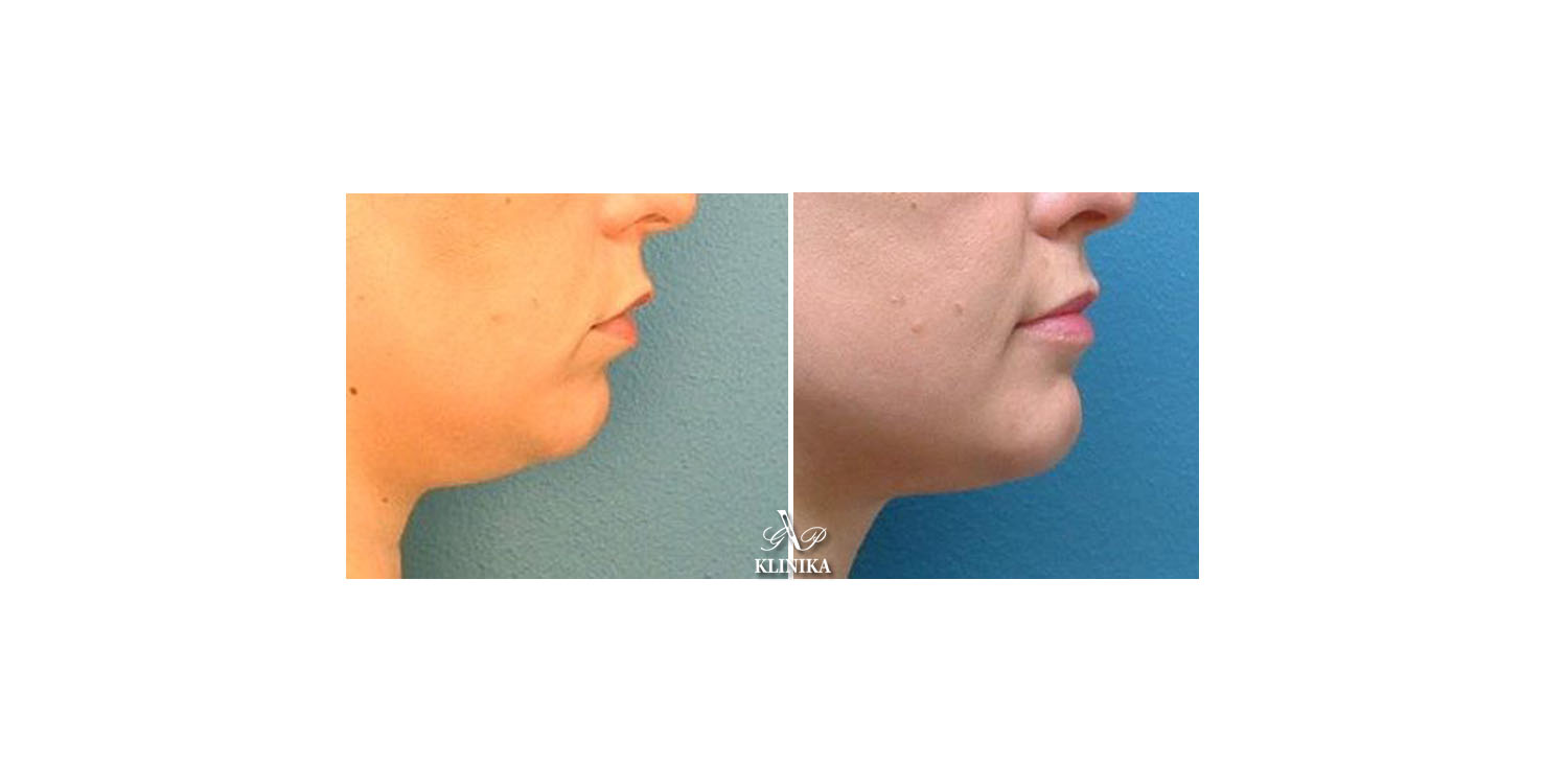 Corrections of the lower part of the chin